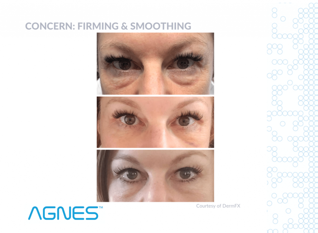 agnes-before-and-after-firming-and-smoothing-eyes_orig