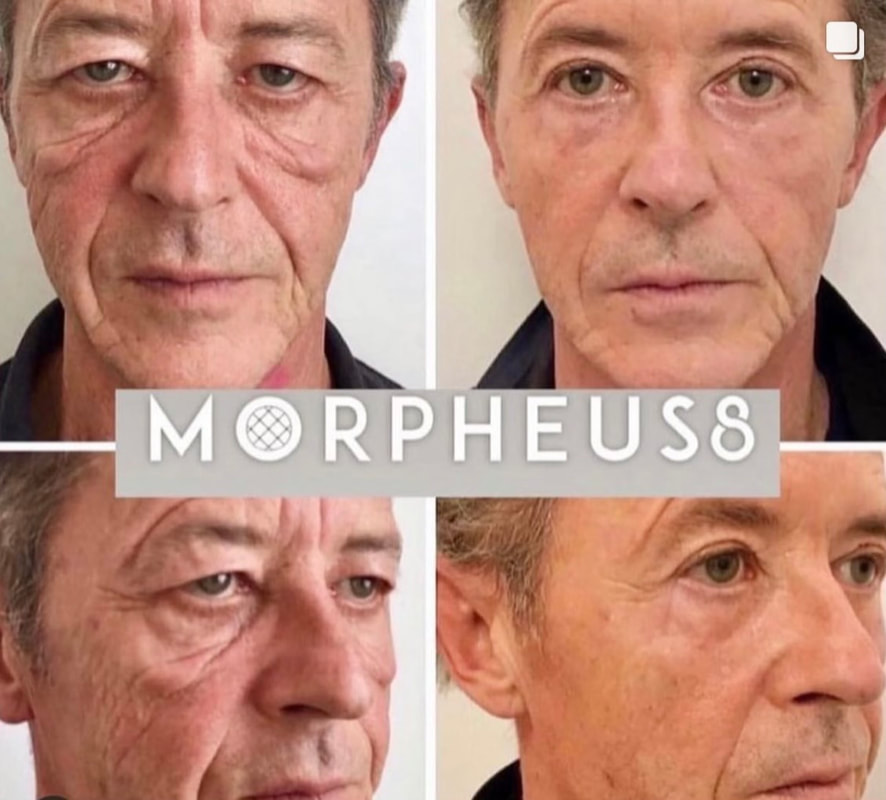 morpheus8 results 5