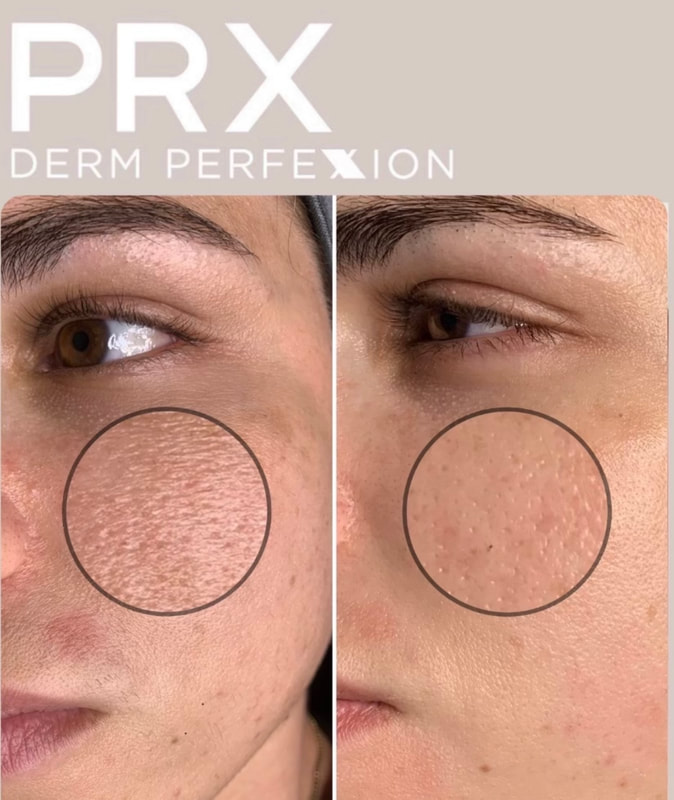 prx derm perfexion results 2