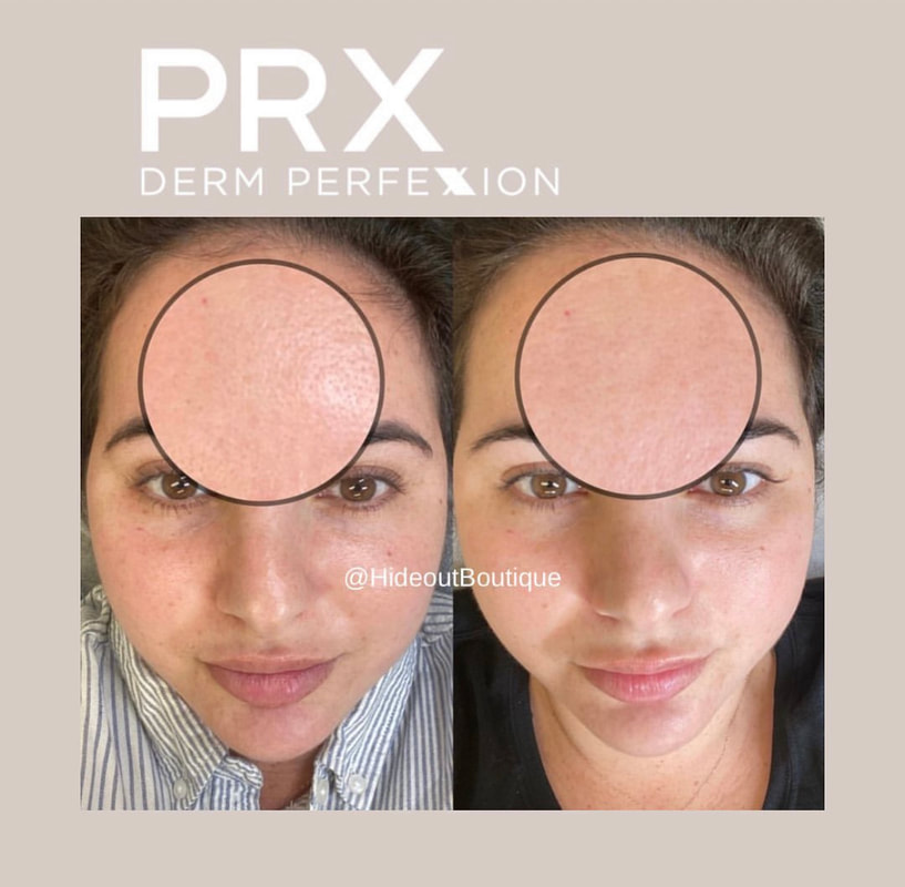 prx derm perfexion results 3