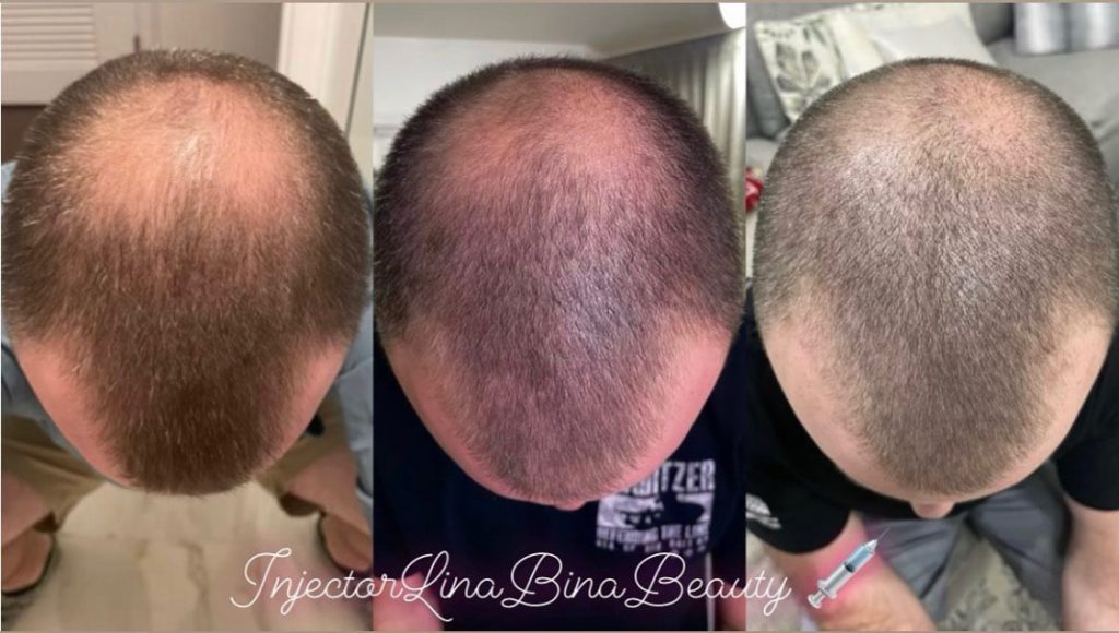 Before and after shot of first round of Bioregenerative plasma gel injections male scalp